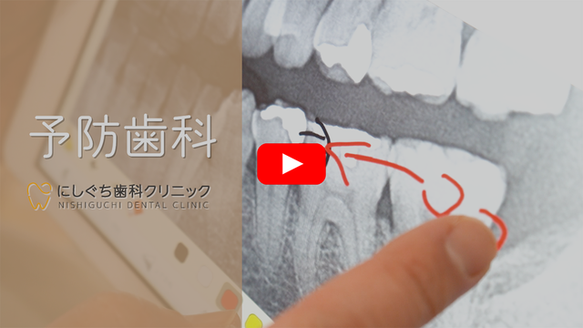 予防歯科動画